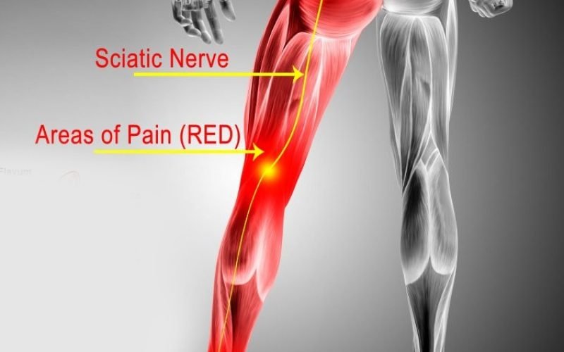 Sciatica-Hip-Pain-Causes-Treatment
