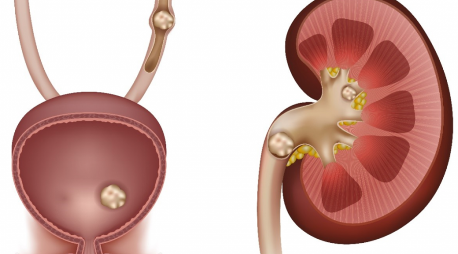 kidney_stone_symptoms-1024x800